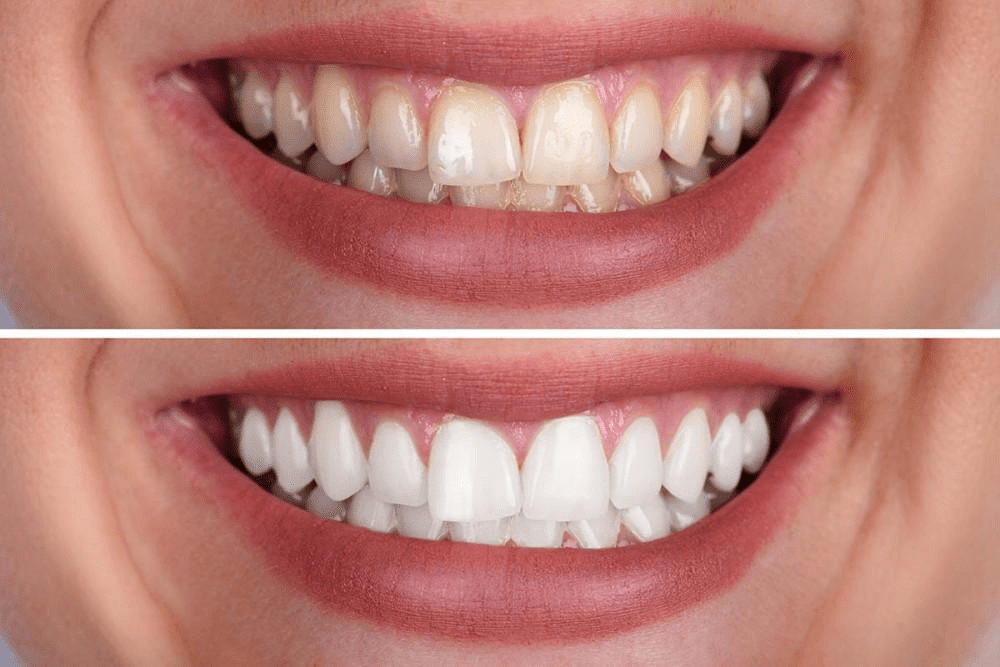 Benefits of laser teeth whitening:
