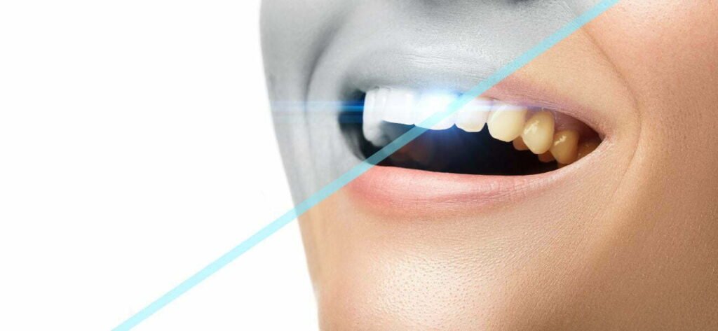 Laser Teeth Whitening