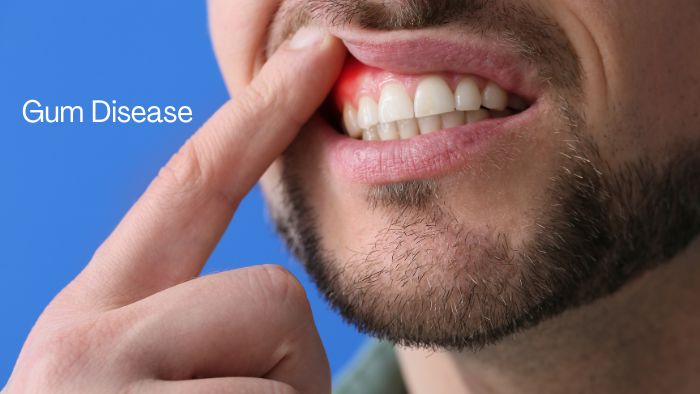 Gumdisease or Periodontitis is a most common dental 