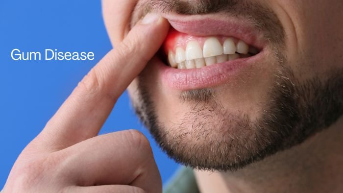 Gumdisease or Periodontitis is a most common dental 