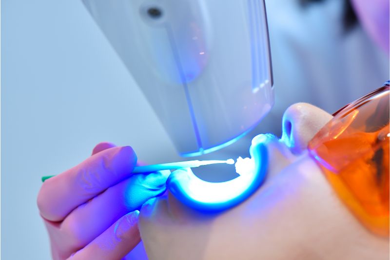 laser Teeth Whitening