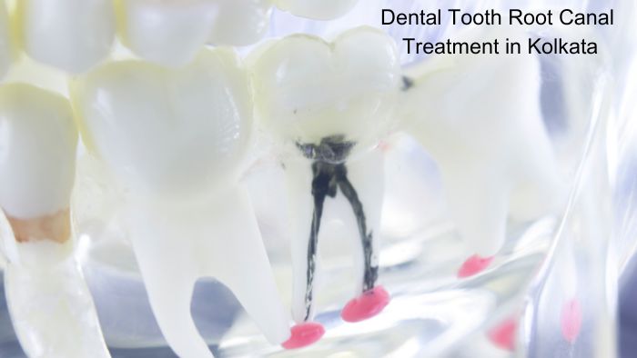 dental tooth root canal treatment in kolkata 